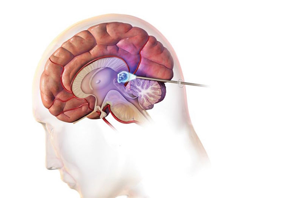 Neuroendoscopy