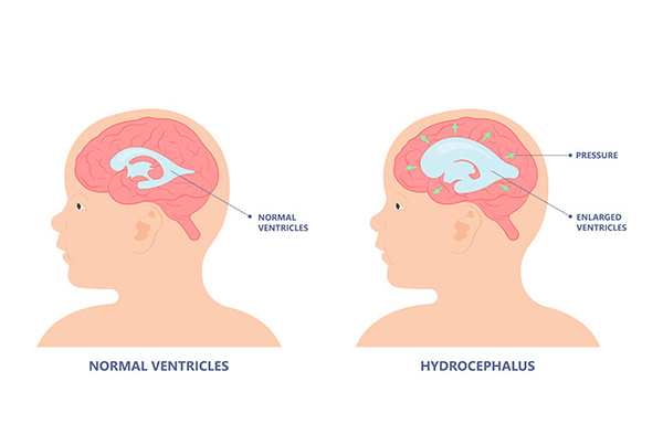 Hydrocephalus