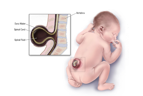 Meningomyelocele