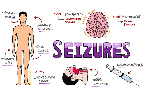 Seizure