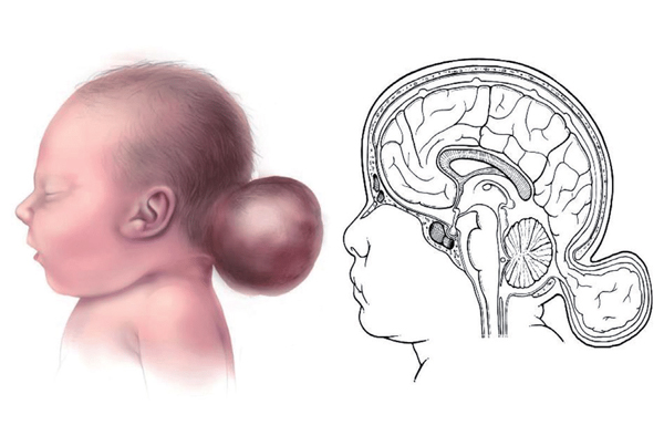 Encephalocele