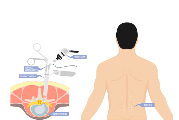 Endoscopic Spine Surgery